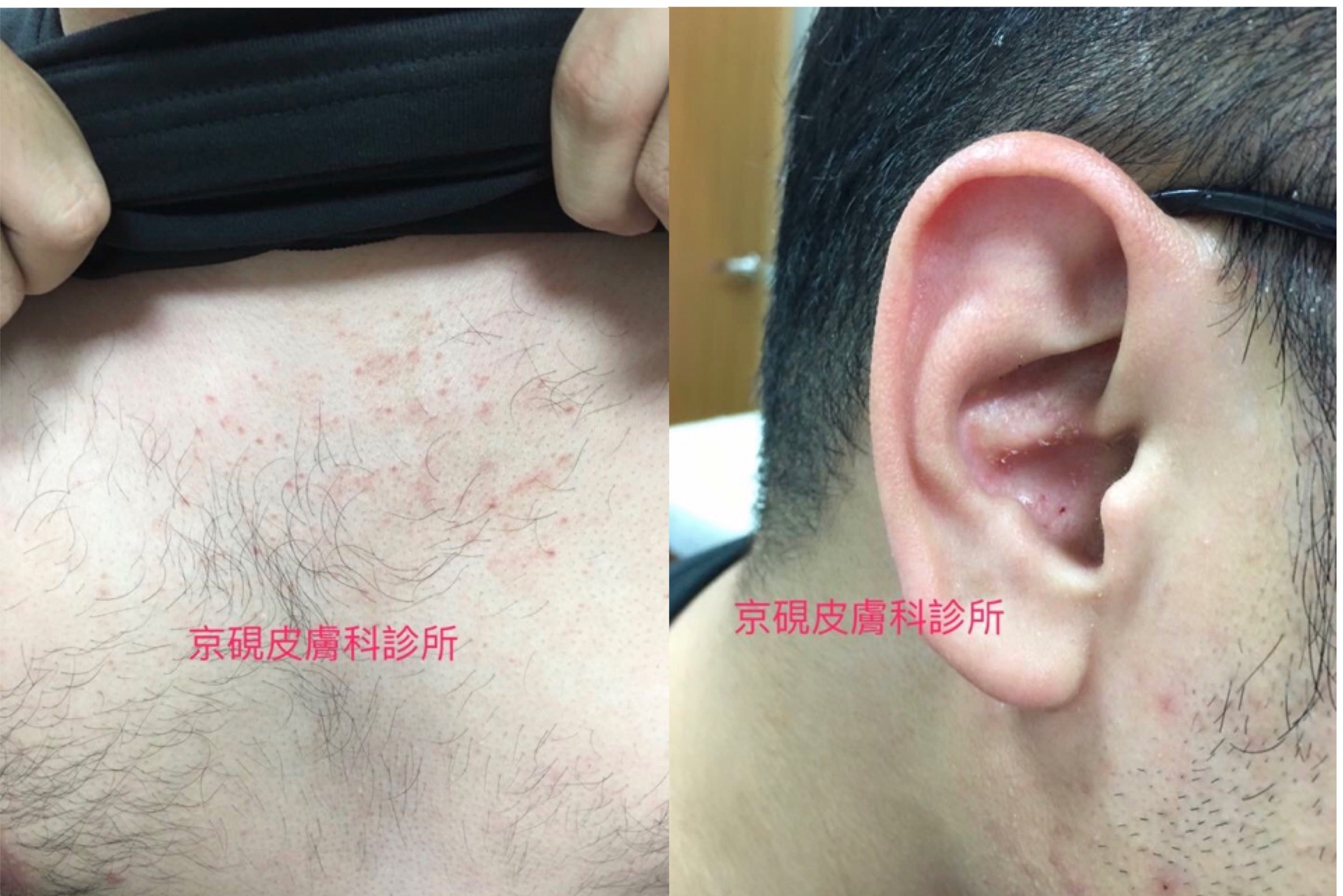 頭皮 性 画像 漏 皮膚 炎 脂