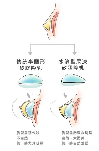 隆乳, 水滴型果凍矽膠, 京硯整形外科, 京硯聯合診所, 張耀元