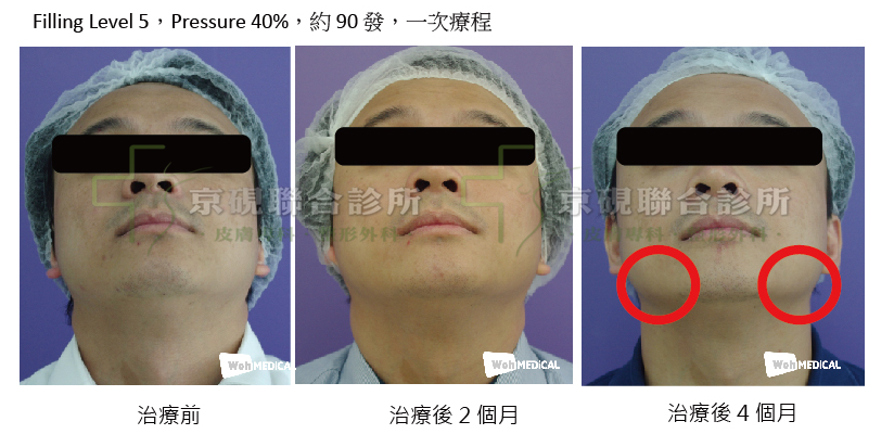 JVR氣動脈衝 JVR氣動脈衝