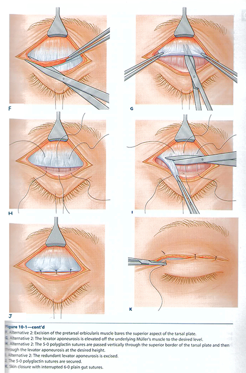 提眼瞼肌,外開式提眼瞼肌手術
