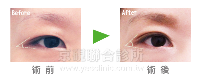 開眼尾, 眼部整形, 京硯整形外科, 京硯聯合診所, 張耀元 開眼尾, 眼部整形, 京硯整形外科, 京硯聯合診所, 張耀元