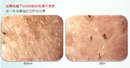 活氧泡泡, 泡泡電波, 雷射光療