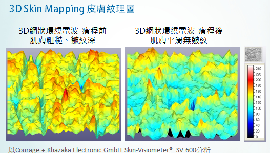 3D網狀環繞電波, 泡泡電波, 雷射光療